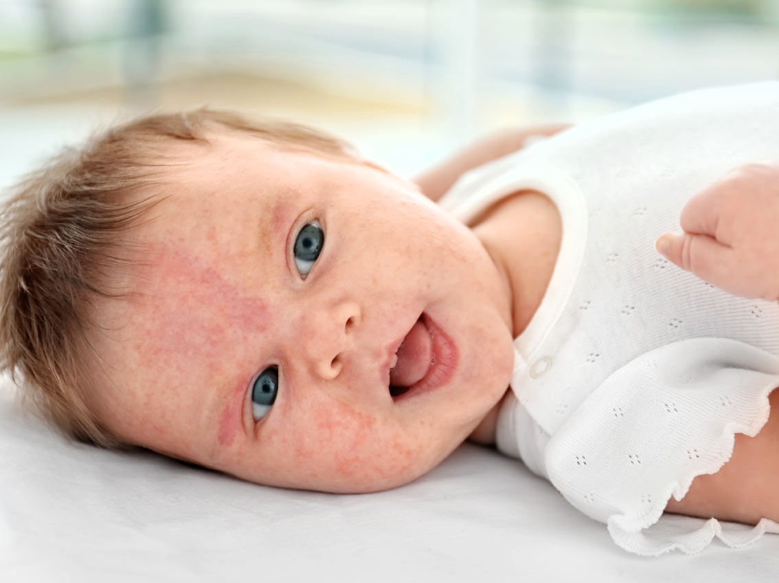 اعراض حساسية الالبان عند الرضع وطرق علاجها