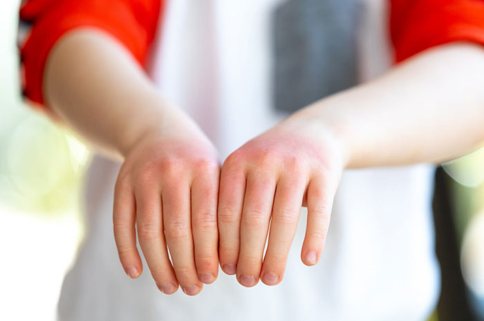 ما هو علاج الاكزيما اليدين وهل تنتشر الإكزيما في الجسم؟