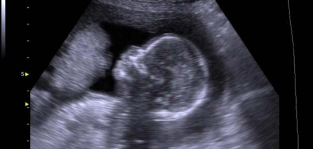 متى يظهر الجنين في كيس الحمل في اي اسبوع؟