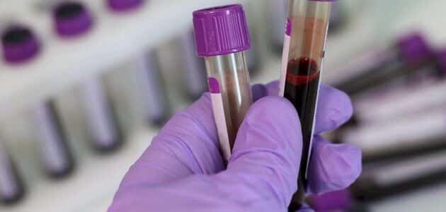 هل يظهر سرطان القولون في تحليل الدم وكيف يتم تشخيصها؟